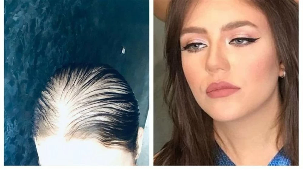 أخطاء التجميل تشوّه مسيرة نجمات الفن المصري والعربي